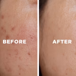 Remove Acne Scars at Home