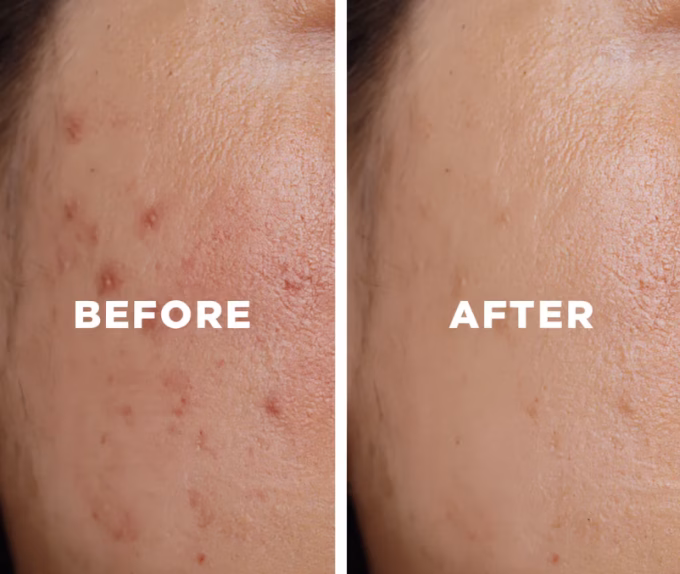 Remove Acne Scars at Home