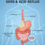 GERD and acid reflux illustration in human digestive system