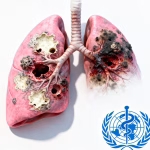 WHO Reports TB as Leading Infectious Killer Globally