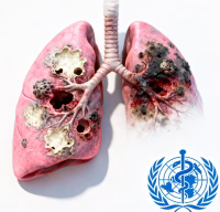 WHO Reports TB as Leading Infectious Killer Globally